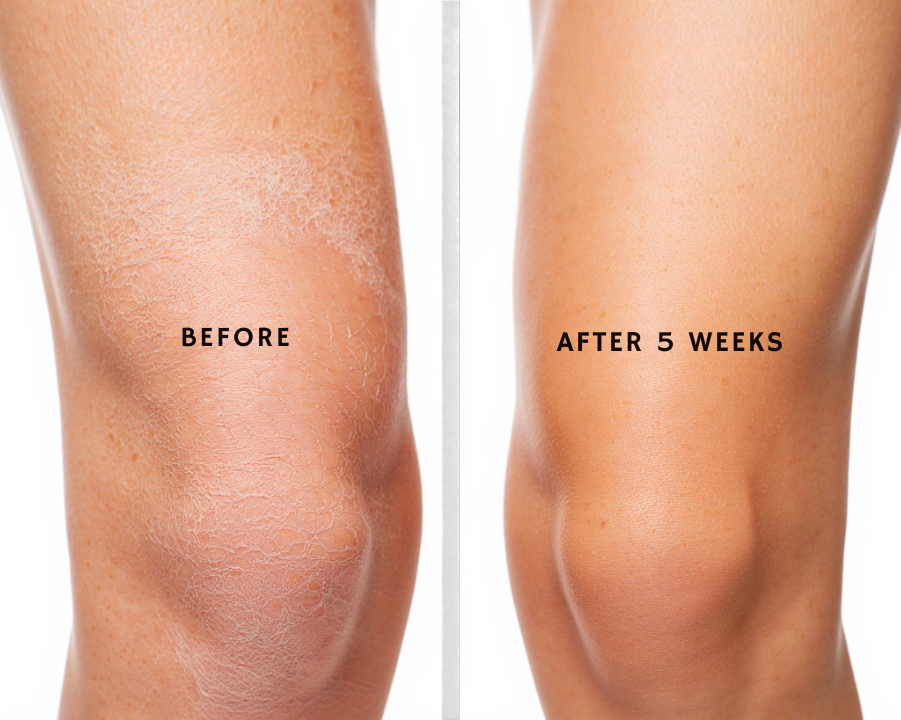 Before and after comparison of a knee treatment showing improvement over 5 weeks.