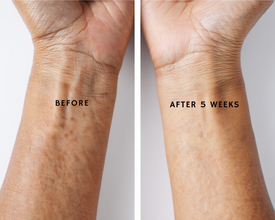 Before and after comparison of a skin treatment on a wrist.